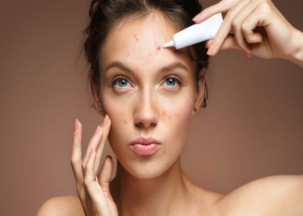 sunscreen for acne prone skin 
