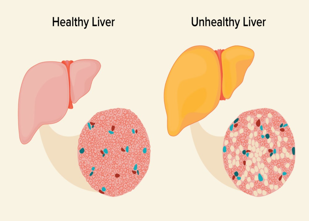 how to reduce fatty liver naturally