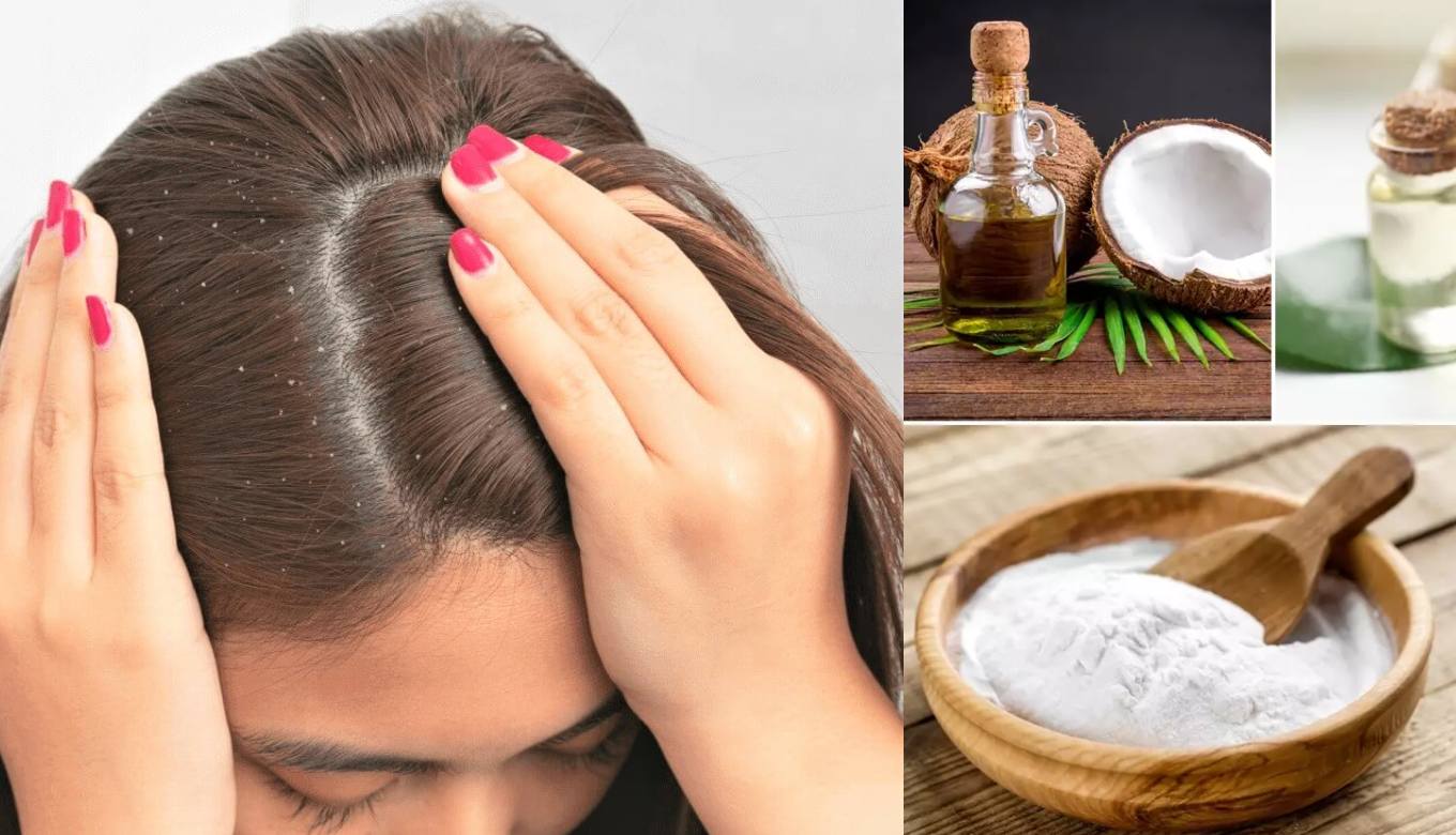 A Complete DIY Dandruff Treatment Guide For Clean And Clear Scalp