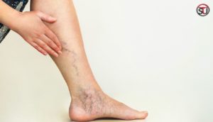 Varicose Veins: Symptoms, Causes and Treatment