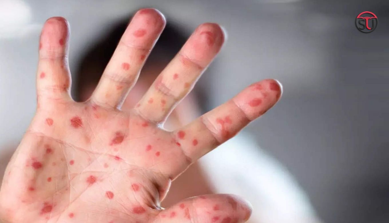 Monkeypox Virus Symptoms, Causes, and Preventive Measures to Know
