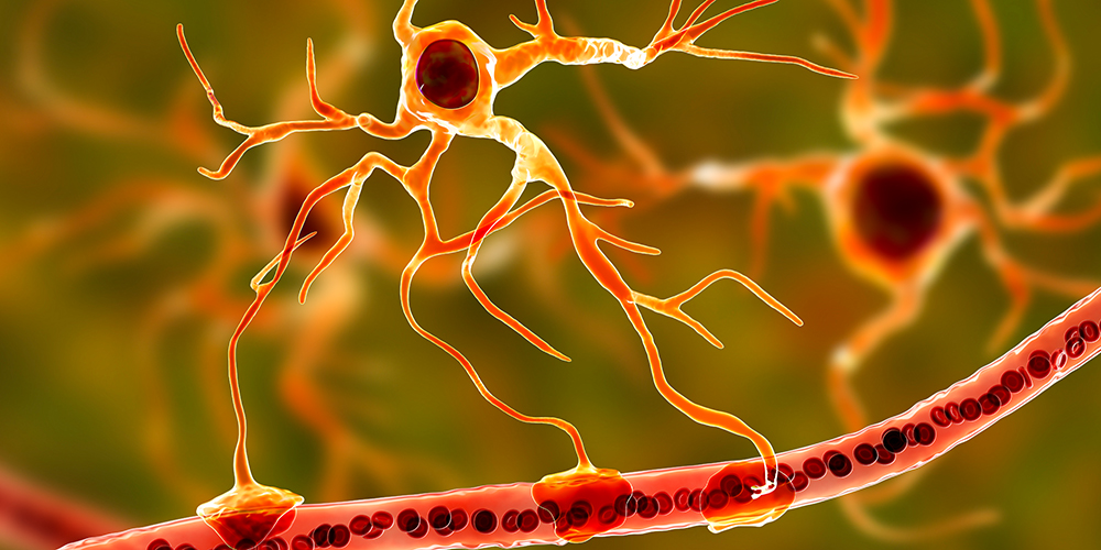 New biomarker for disease progression in multiple sclerosis | University of Basel