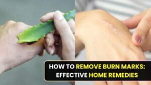 How to Remove Burn Marks: Effective Home Remedies