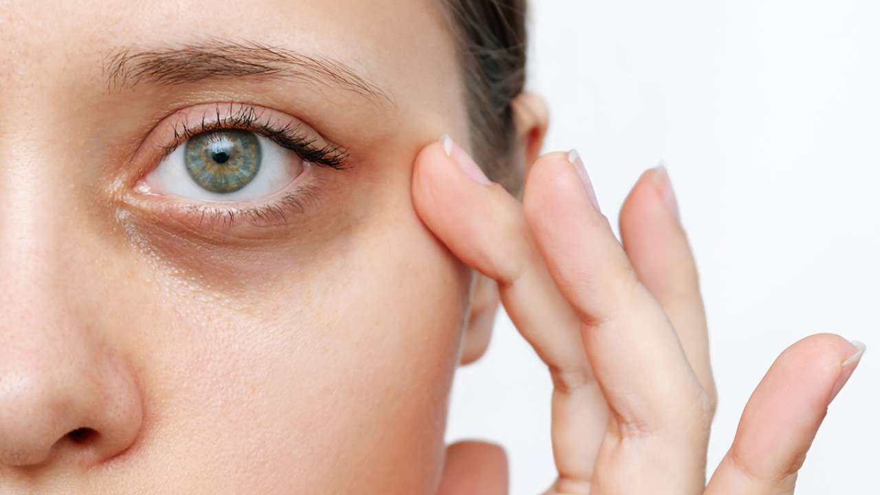 Dark Circles: Not Just Lack of Sleep, These 8 Big Reasons Are Behind Them!